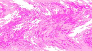 Bright pink abstract shards representing the confined tumor mass of localized mesothelioma